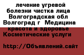 лечение угревой болезни,чистка лица - Волгоградская обл., Волгоград г. Медицина, красота и здоровье » Косметические услуги   